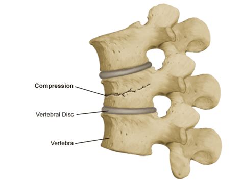 In my understanding, the backbone refers to the feature extracting network which is used within the deeplab architecture. Compression Fracture | Nervous system problems, Fracture, Fractures