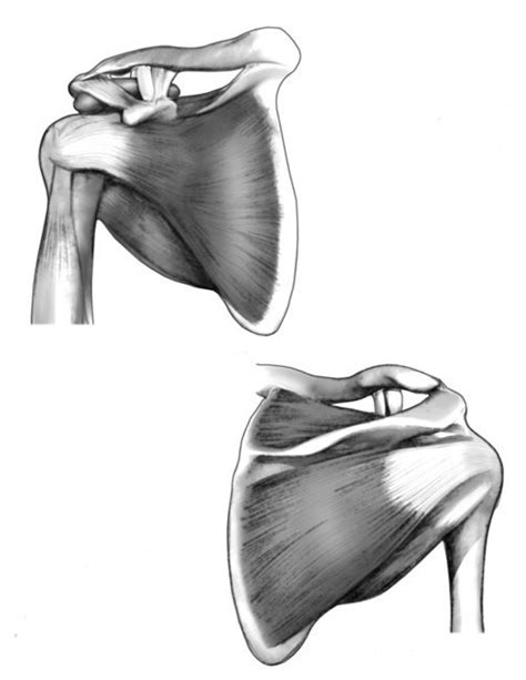 Rotator Cuff Shoulder Pain Impingement Tears And Referred Pain 2021