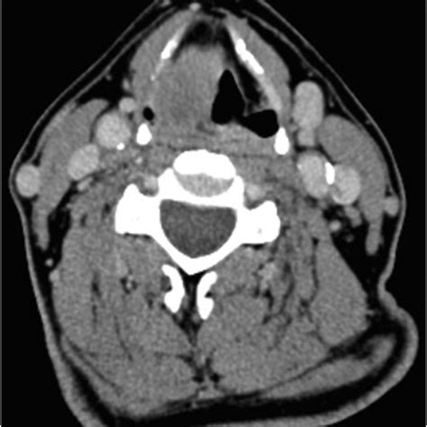 Cervical Ct Tumor In The Right Hemilarynx Without Cervical Adenopathy