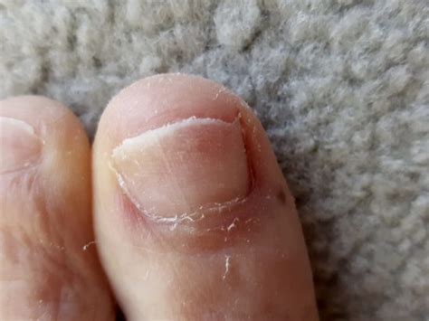 Toenail fungal infections are typically painless or at least start white vinegar is one of the best ingredients in treating toenail fungus because it fights the published may 17, 2010. Nail Fungus Treatment Over The Counter - Lifestyle Fifty ...