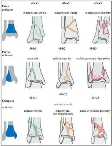 AO OTA Classification System Type Distal Tibial Fracture Download Scientific Diagram