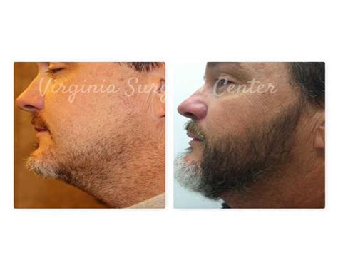 If you are considering undergoing a hair transplant, it is a good idea to know what to expect before undergoing the procedure. Facial Hair & Eyebrow Transplant Treatment in McLean, VA
