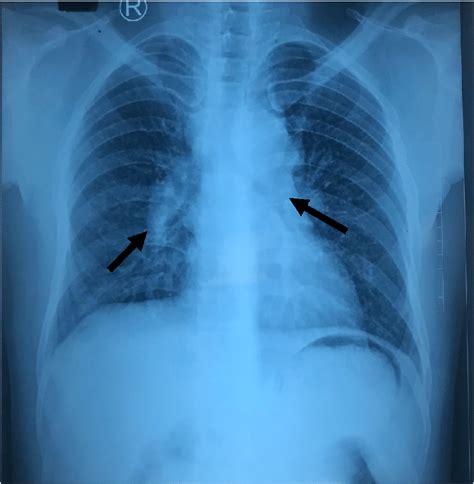 Chest Radiograph Showing Bilateral Symmetric Hilar Ly