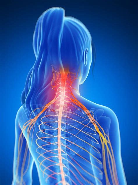 St Louis Cervical Radiculopathy Neck Pain Car Accident Injury St