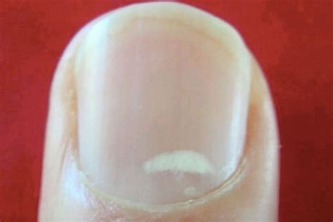How To Remove White Spots On Nails White Spots On Nails White Spots