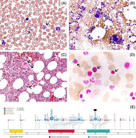 Peripheral Blood And Bone Marrow Morphological Findings And Mutational