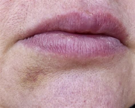 Jejunes Place Lip Biopsy — What To Expect