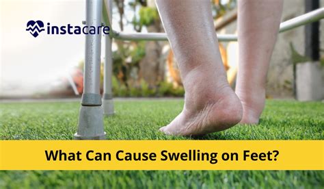 What Causes Swelling On Feet 7 Causes Treatments And Remedies