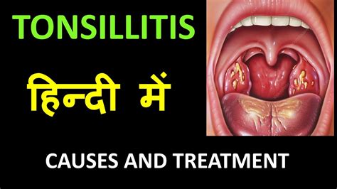 Tonsillitis Infection Of Tonsils In Hindi Youtube