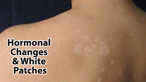 Hormonal Changes And White Patches Youtube