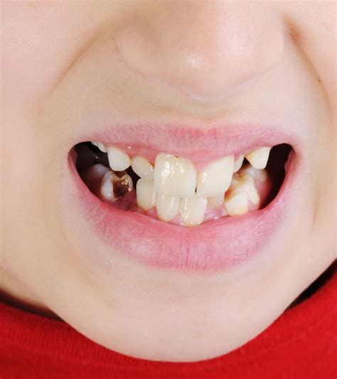 7 Causes Behind Discolored Teeth In Children And Treatment 188bet体育平台