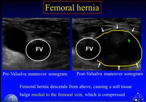Femoral Vs Inguinal Hernia Ultrasound Images And Photos Finder