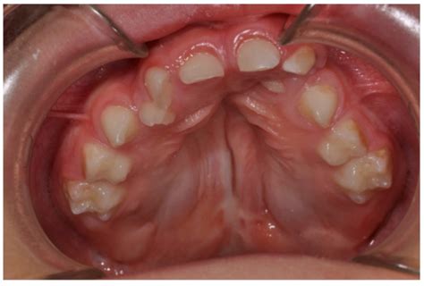 Cleft Lip Palate Patient Encyclopedia Mdpi