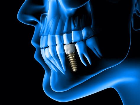 How Long After Implant Placement Can You Get A Dental Implant