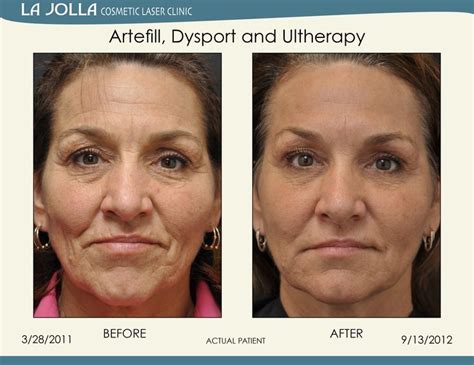 Patient Treated With Artefill Dysport And Ultherapy At La Jolla