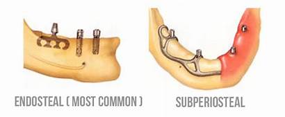 Implants Implant Dental Types Endosteal Different Tooth