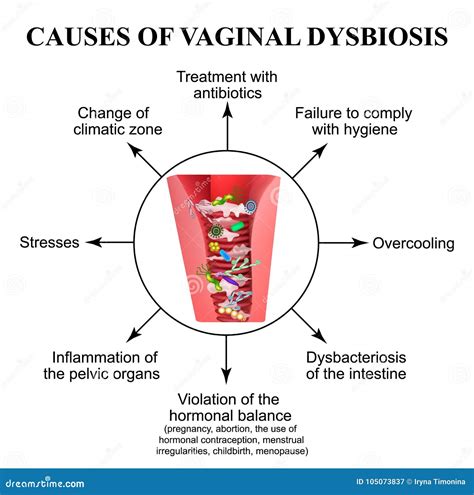 Causes Of Vaginal Dysbiosis Vaginitis Candidiasis Infographics Stock