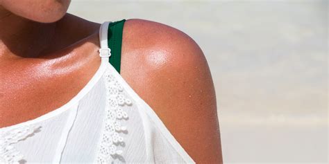 How To Tell The Difference Between A Bad Sunburn And Sun Poisoning