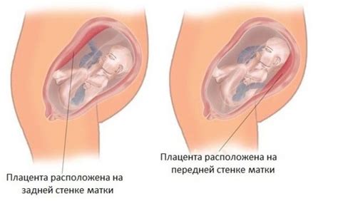 Плацента по передней стенке в дне матки