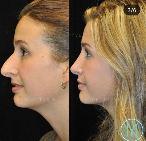 Nose Plastic Surgery Nose Surgery Botox Hooked Nose Rhinoplasty