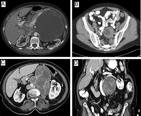 Diagnosis And Management Of Retroperitoneal Ancient Schwannomas World