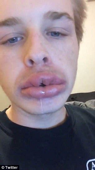 New Kylie Jenner Challenge Leads To Bruised Lips Photo