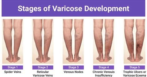 Varicose Veins Specialist St Louis Mo And Evergreen Park Il Midwest Institute For Non