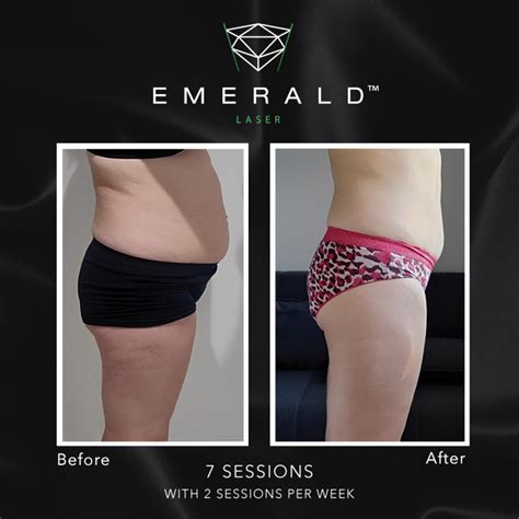 Emerald The Award Winning Fat Loss Laser Works Up To BMI