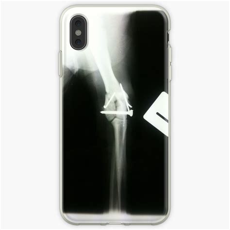 How to xray photos without photoshop. "xray Iphone" iPhone Case & Cover by AmandaCole | Redbubble