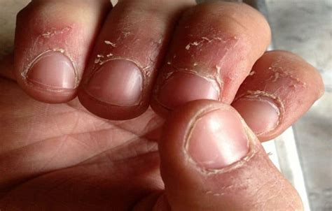Skin Peeling On Fingers Near Nails Causes And Remedies
