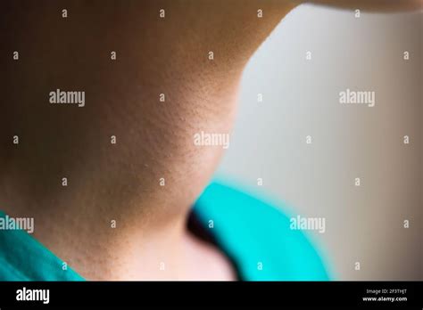 Goiter Hi Res Stock Photography And Images Alamy