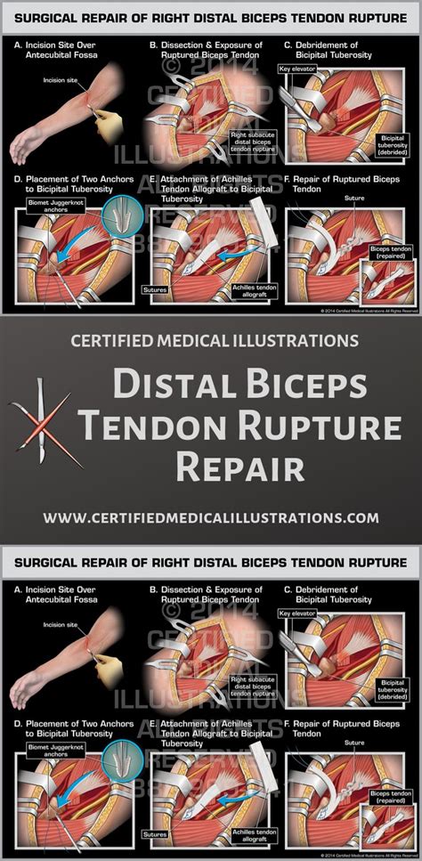 How To Rehab A Strained Bicep Tendon