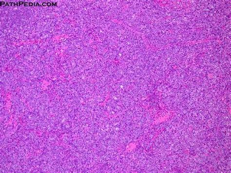 Intensive chemo using several drugs is. Histopathology images of Angioimmunoblastic T-cell ...