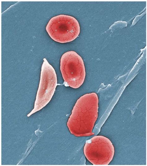 Globulos Rojos De Pacientes Con Sicklemia Actitud Saludable