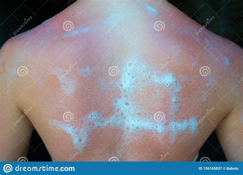 Sunburned Girl With Cooling Foam On Her Back Stock Image Image Of