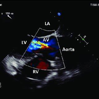 2D Mid Esophageal RV Inflow Outflow View With Color Flow Doppler
