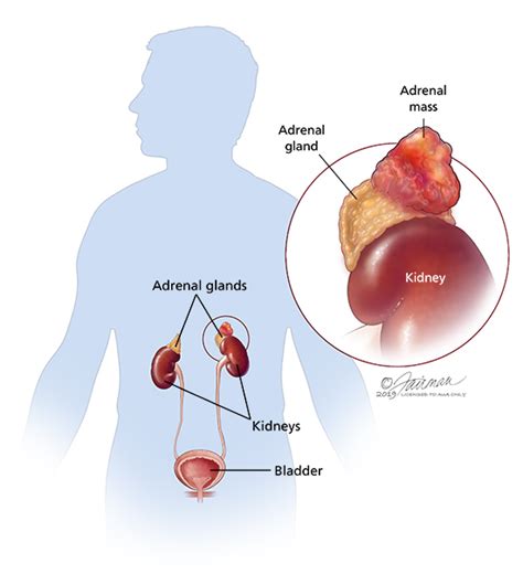 Pheochromocytoma Adrenal Medulla Tumor Symptoms Diagnosis And Treatment Urology Care Foundation