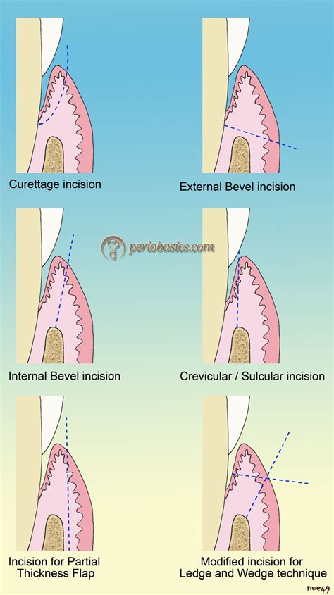 Periodontal Flap Surgeries Current Concepts