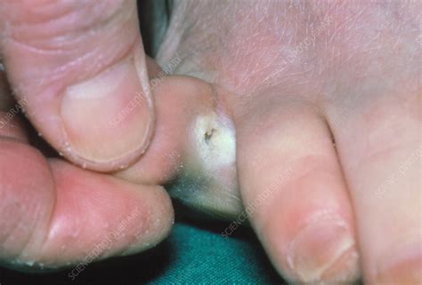 Close Up Of Athlete S Foot Tinea Pedis Infection Stock Image M270