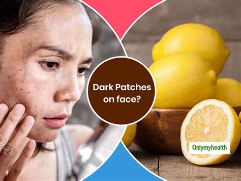 Home Remedies For Dark Patches On Face Dark Spots Or Patches Can Ruin