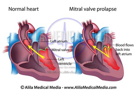 Alila Medical Media Mitral Valve Prolapse Medical Illustration