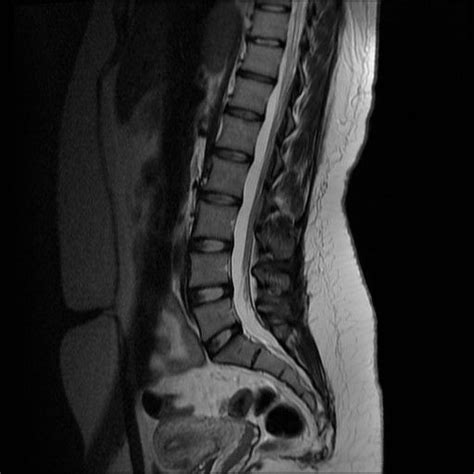 Mri Lower Spine Cpt Mri Scan Images Mri Scan Mri Ct Scan