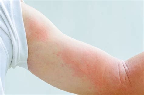 Dermatite Da Sudore Cause Sintomi Rimedi E Prevenzione
