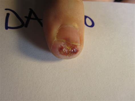 Trauma Open Method Of Treating A Fingertip Amputation