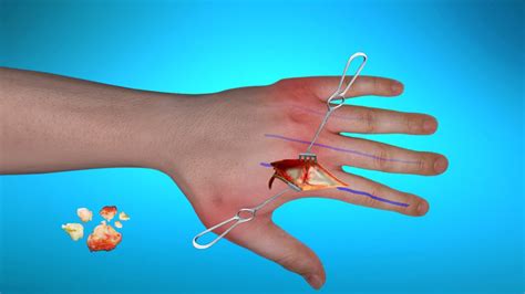 Surgical Treatment For Rheumatoid Arthritis Of Hands Youtube