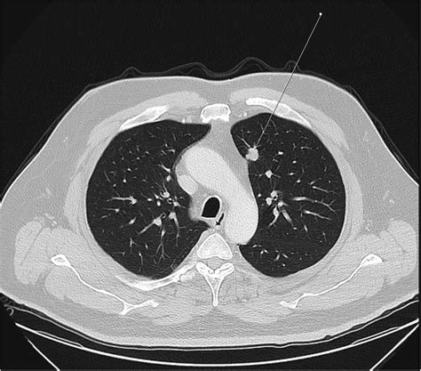 Pre Operative Chest CT Scan Showing The Location Of Pulmonary Nodule In