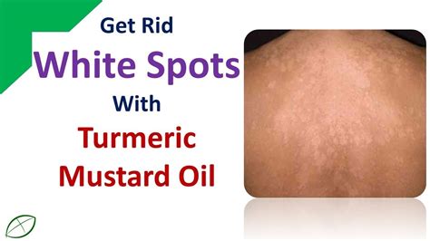Home Remedies To Get Rid Of White Spotsget Rid White Spots With