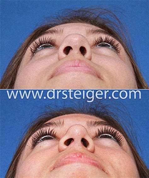 Narrow Nose Job1 Steiger Facial Plastic Surgery Boca Raton Facelift