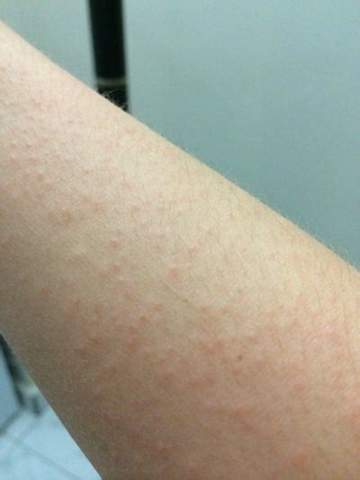 Accutane Rash Popular In Atopic Dermatitis Eczema