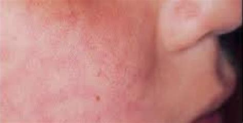 Hiv Skin Rash Images Causes Symptoms Treatment